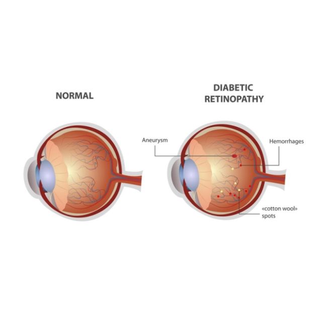 Diabetic Retinopathy – Mahatme Hospital – Eye Bank & Eye Hospital